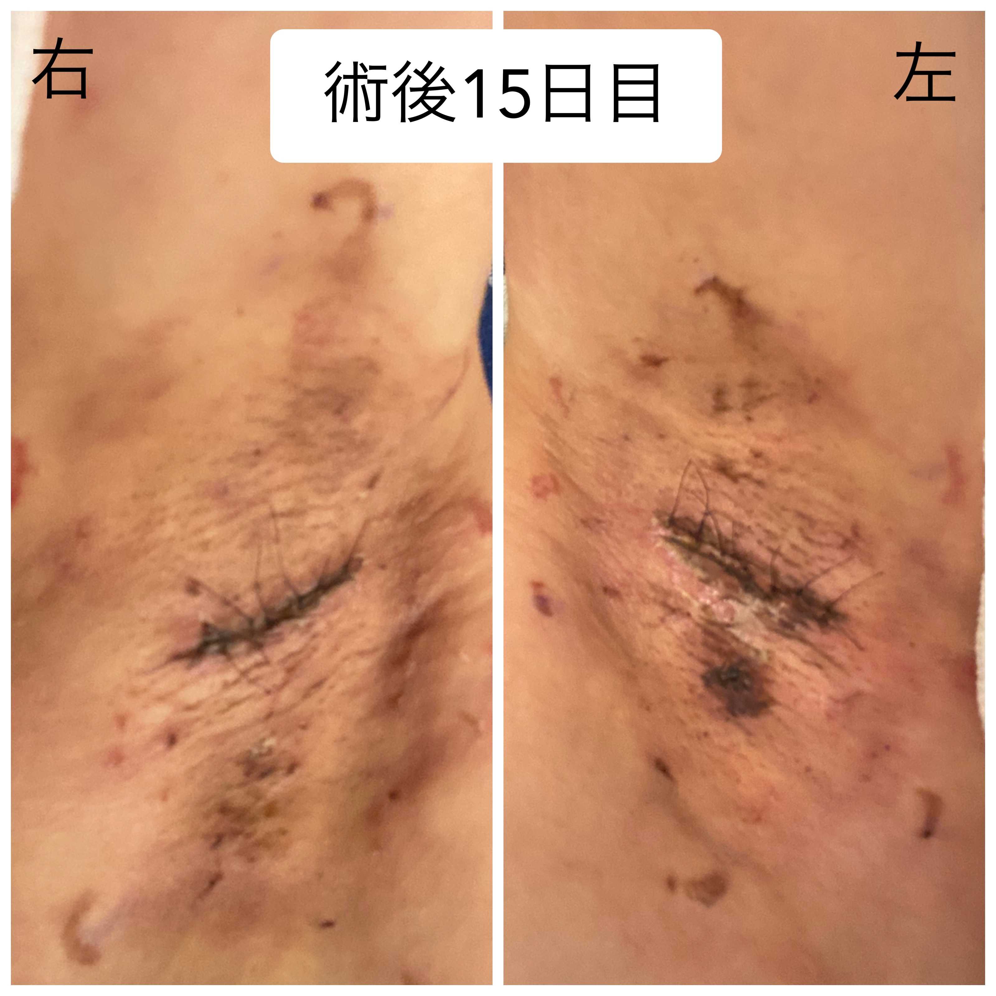 術後15日目 脇の写真あり ぐリどん Blog 楽天ブログ