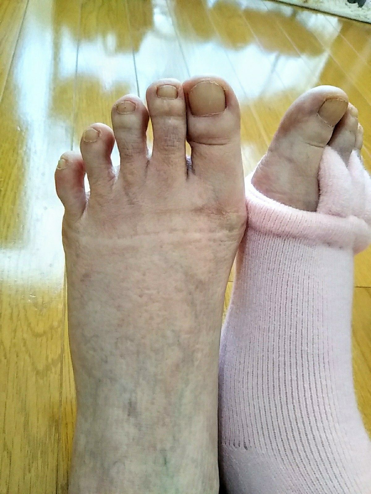 足の指間ヨガソックスの効果 病気と生きる 楽天ブログ