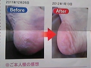 いきいきジェル　かかとのひび割れ