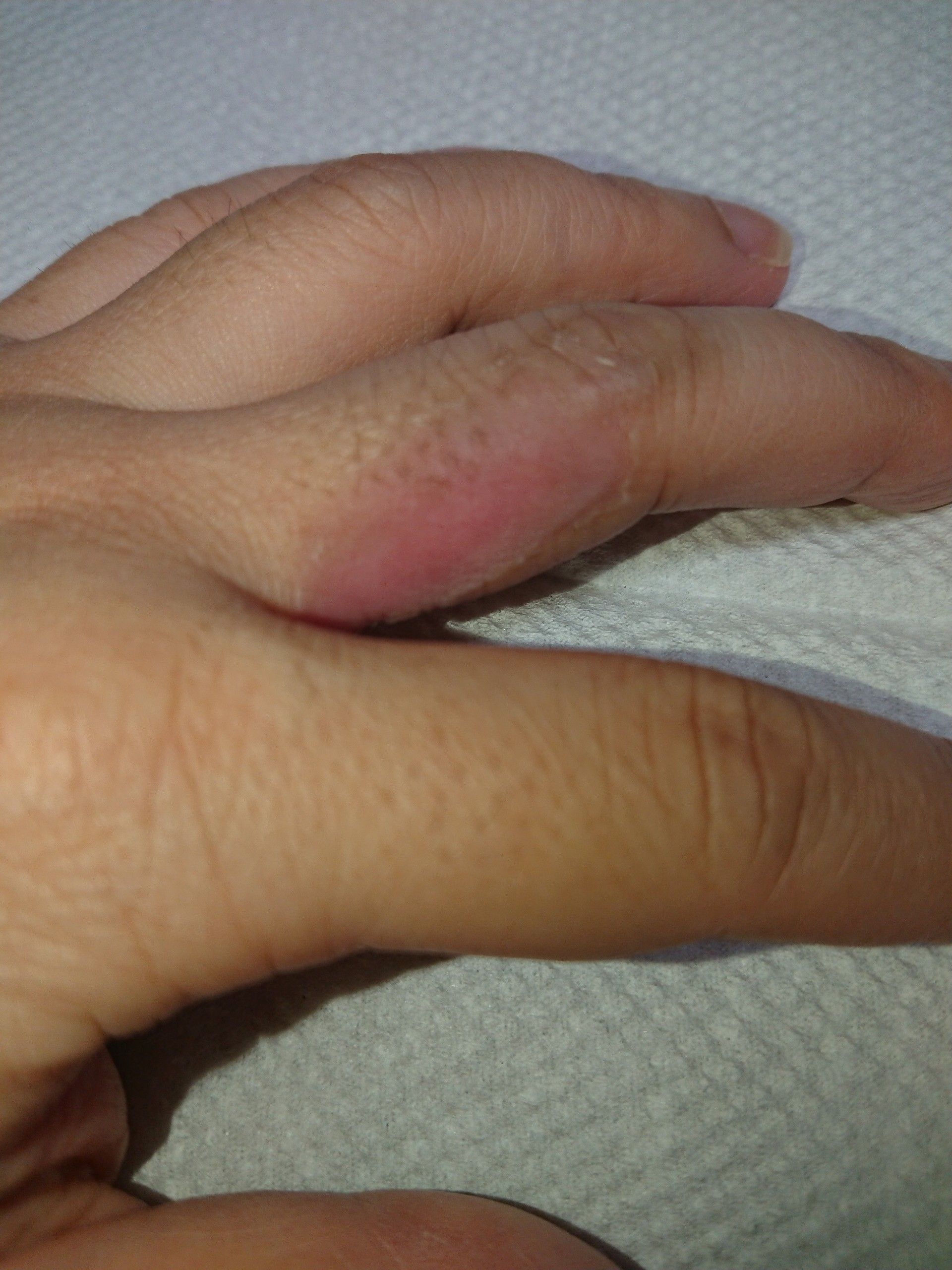 やけどした 粘膜くらいの感じに はっぴーくじらのブログ 楽天ブログ