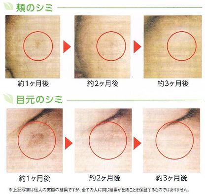 シミ　Before→After(.JPG