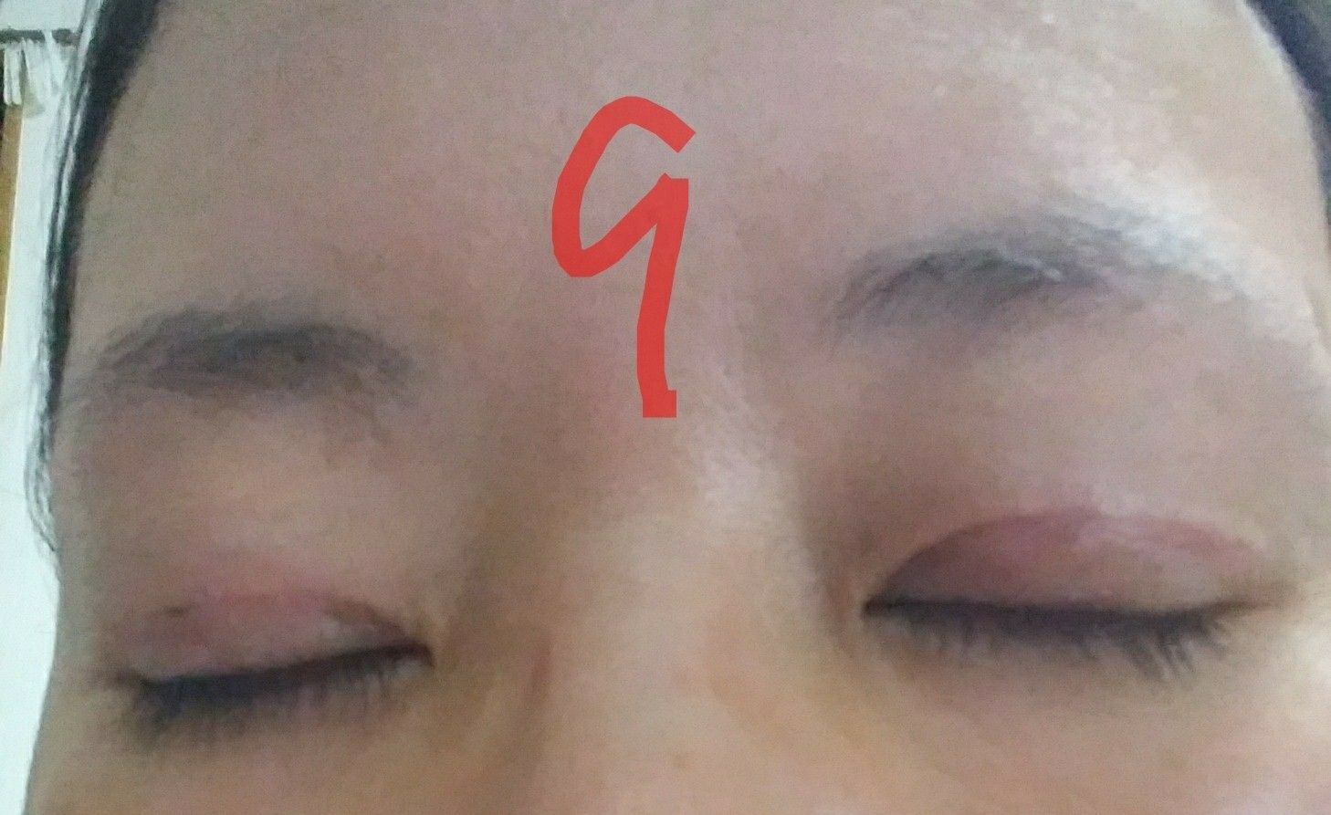 眼瞼下垂 術後9日目 眼瞼下垂手術の記録 楽天ブログ