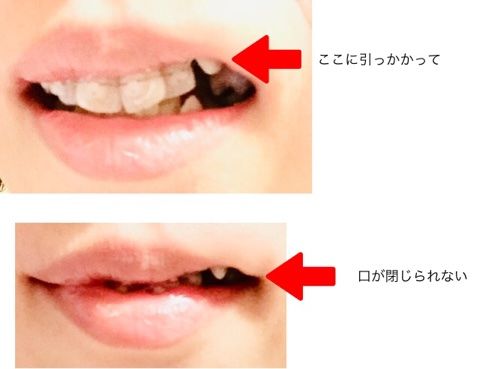 歯列矯正 おひとりさまのシンプルライフ 楽天ブログ