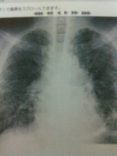 4 肺がん ステージ