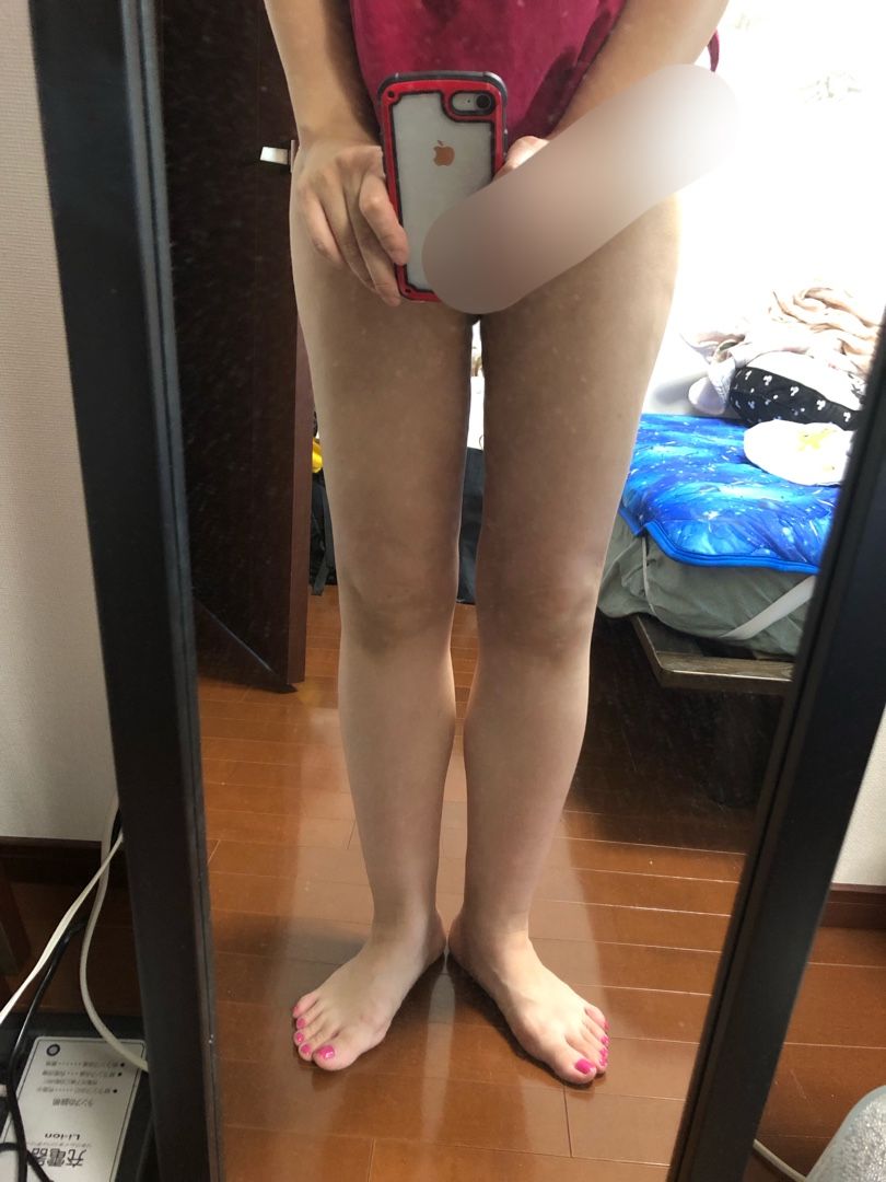 脂肪吸引日目の話 おもちの脂肪吸引の話 楽天ブログ