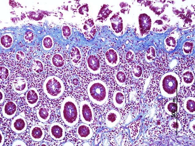 Collagenous colitis | 病理検査の玉手箱 - 楽天ブログ