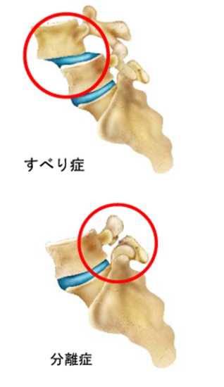 すべり症