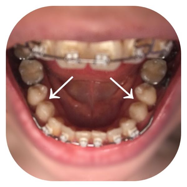 歯科矯正 じわりじわりと奥歯に隙間が 30代のための美と健康の歯科矯正ブログ 楽天ブログ