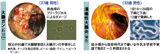 悪い腸