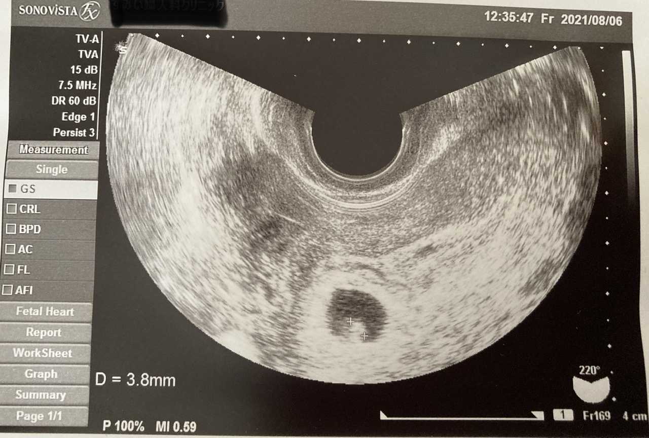 妊娠6週目 不妊治療の末の妊娠記録 楽天ブログ