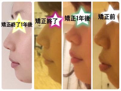 3ページ目の 歯列矯正 しゃけでっぱの歯列矯正 アラサー 楽天ブログ