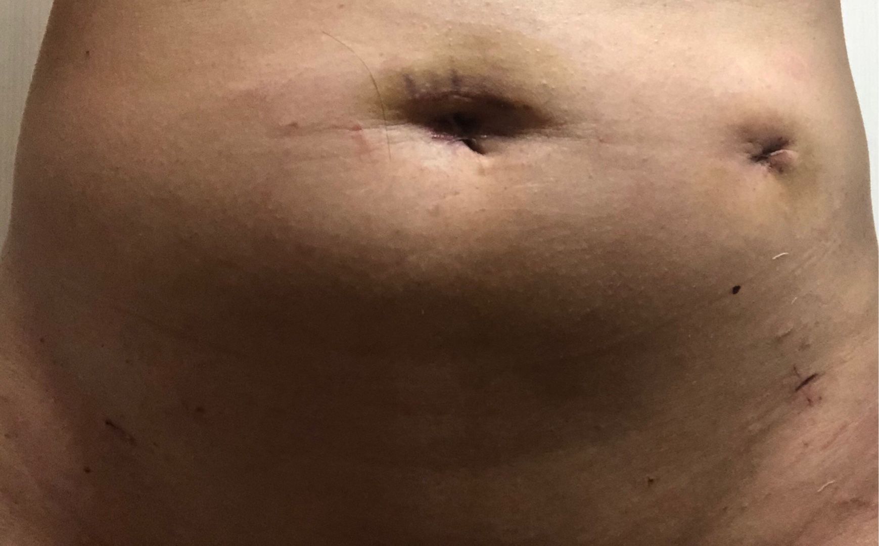 術後3ヶ月 子宮筋腫 珊瑚timeは終わるのか 楽天ブログ