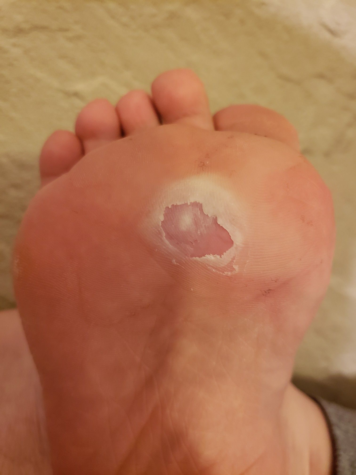 2 お風呂上がりの足裏のイボ うめシロップ 楽天ブログ