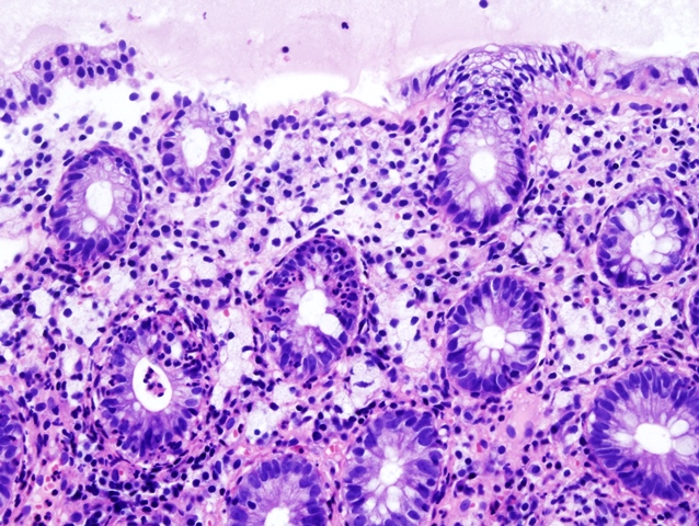 campylobacter_colitis_02