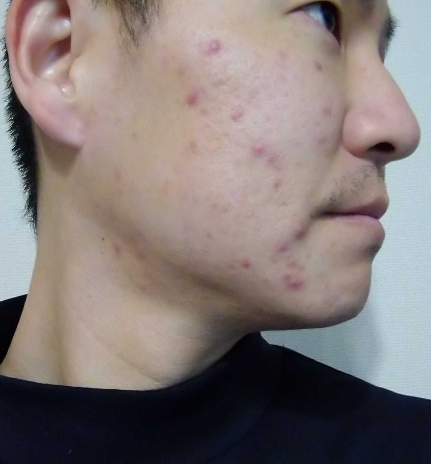 進捗報告でござる 肌荒れニキビよ どこかに行ってくれー 楽天ブログ