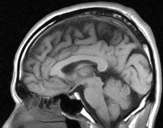 脳MRI2.JPG