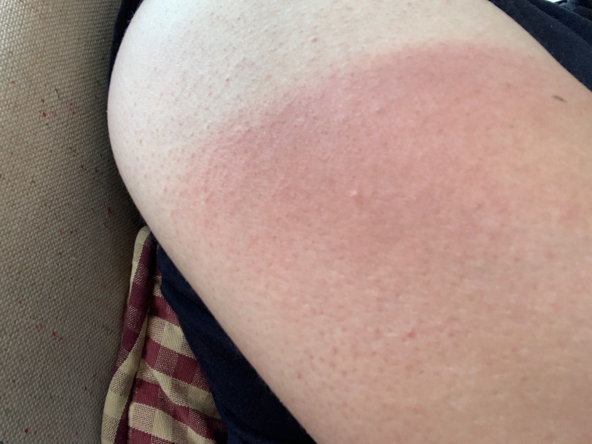 日光アレルギー画像 日焼けではない？意外と多い「紫外線アレルギー」の対策法