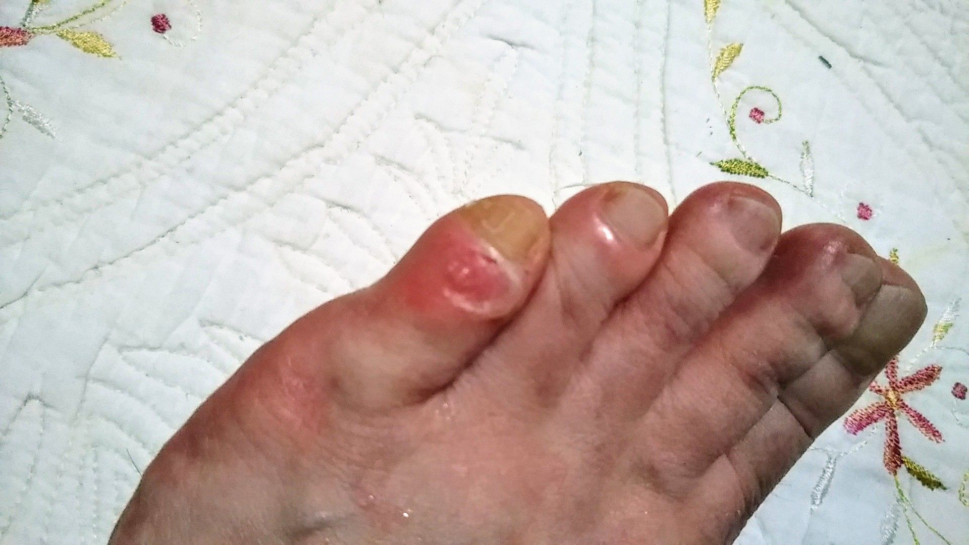 足の指がむくんで皮が剥けた 病気と生きる 楽天ブログ