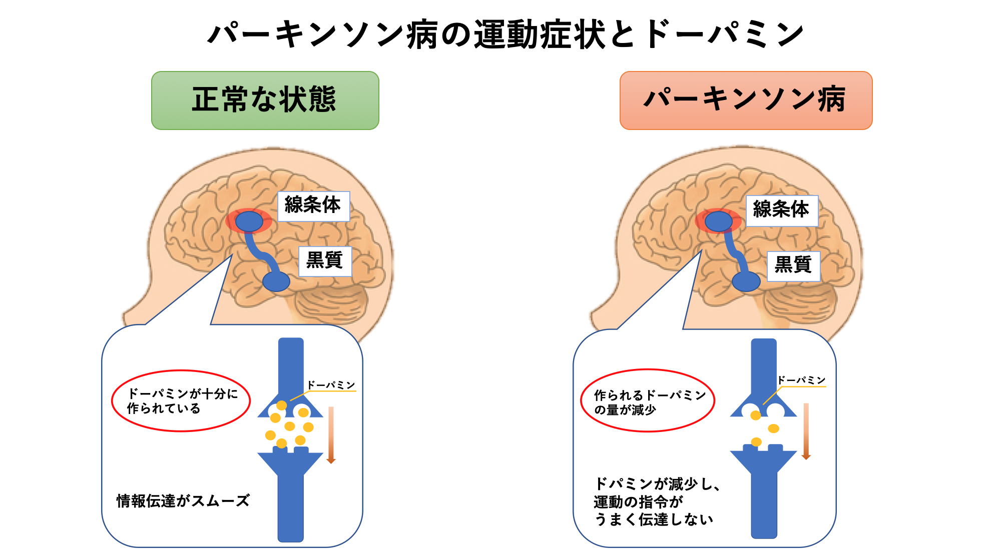 偽パーキンソン病の原因は何ですか?