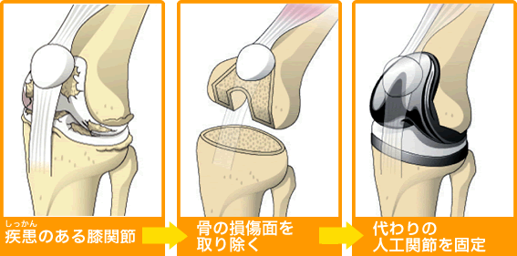 全人工膝関節置換術』 | 葡萄座のおやじブログ - 楽天ブログ