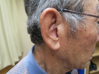 整体すると 動脈硬化の為の耳たぶの深いシワも改善されます 笹岡整骨院の独り言 東洋医学の現場で働く治療師日記 楽天ブログ