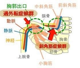 胸郭出口症候群 リハビリ の記事一覧 胸郭出口症候群の手術 頸椎椎間板ヘルニア脊髄症 闘病経過録 楽天ブログ