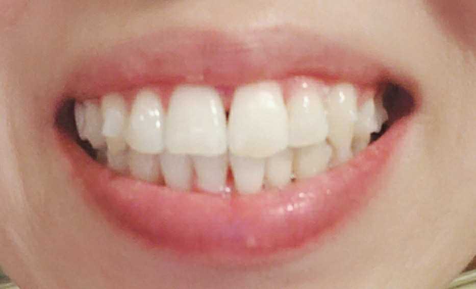 インビザライン アライナー14/15 2日目 アラフォーママの生活~後悔しない人生を 楽天ブログ