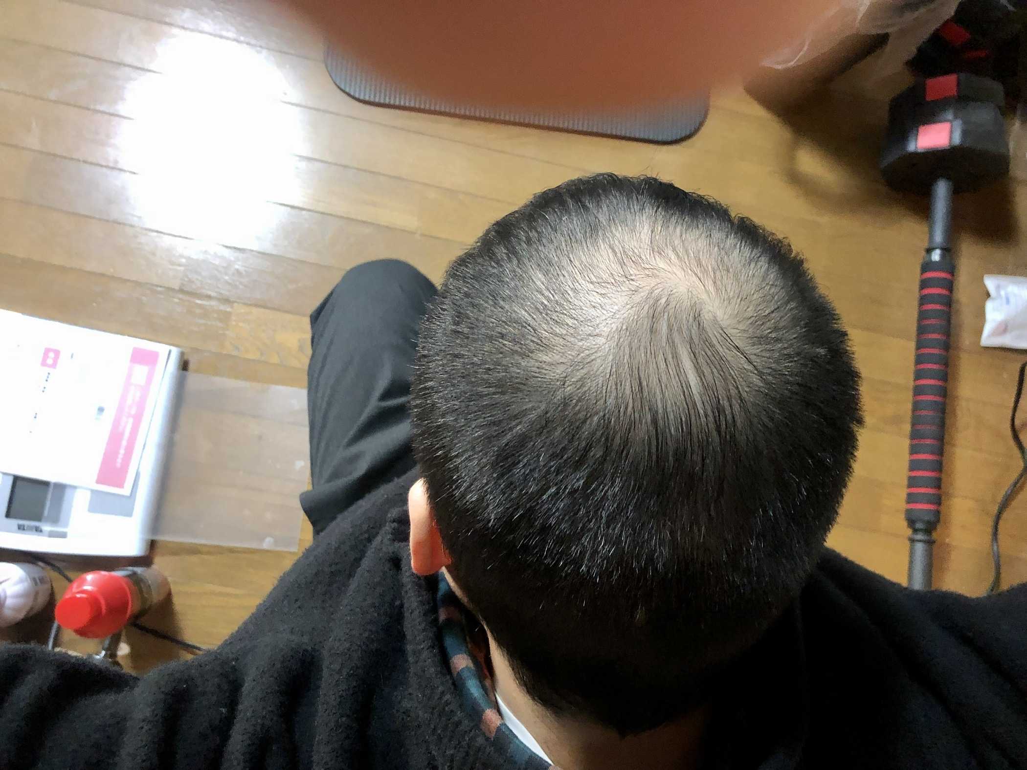 脱agaを目指して 脱agaフサフサの髪を目指して 楽天ブログ 脱agaを目指して 脱agaフサフサの髪を目指して 楽天ブログ