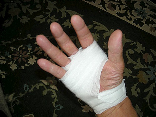 バネ指、右手３本　手術2013.09.19-01 002.jpg