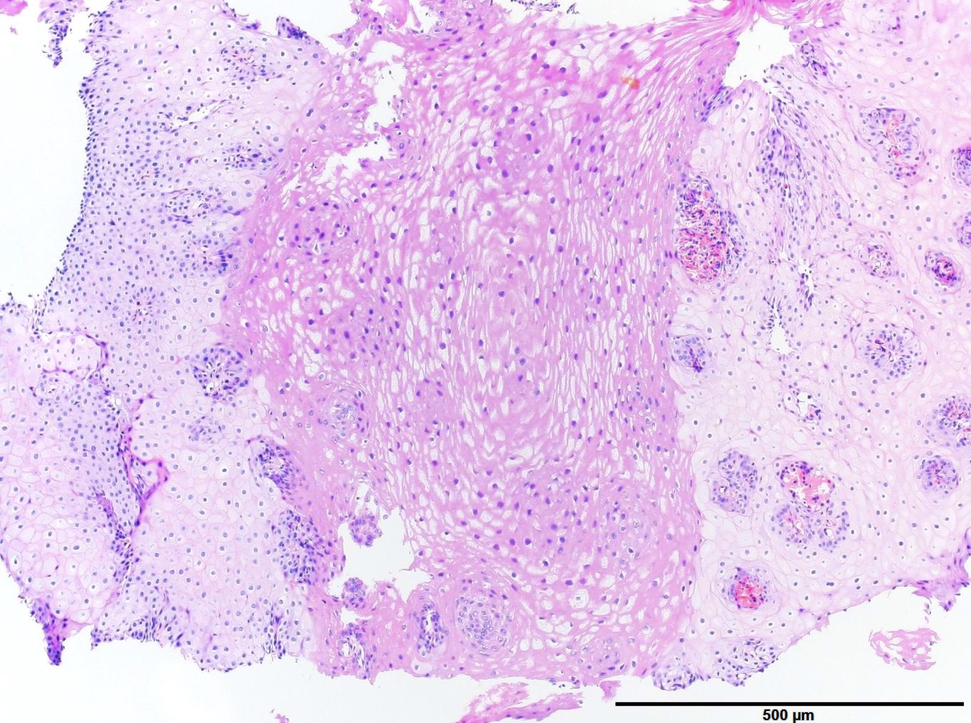 Sloughing esophagitis (Esophagitis dissecans superficialis) | 病理検査の玉手箱 ...