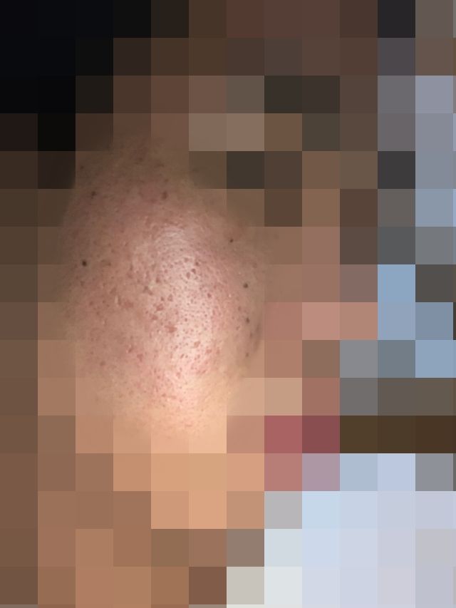 ダーマペン施術直後ダウンタイムについて その3 閲覧注意 ニキビ跡の画像を見たくない方は 閲覧をお控えください ニキビ跡セルフダーマペン治療ブログ 楽天ブログ