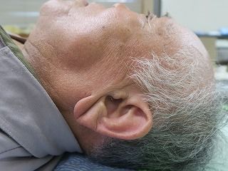 耳たぶに深いしわがある人は、動脈硬化、糖尿病、脳血管性疾患に罹りやすい | 笹岡整骨院の独り言･･･東洋医学の現場で働く治療師日記 - 楽天ブログ