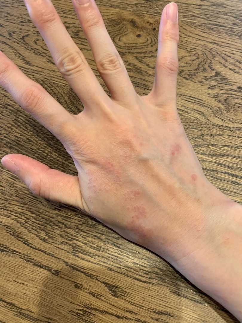 手荒れと保湿を考える 晴れたらハンモック 楽天ブログ