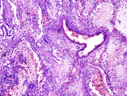 pseudomonas_pneumonia_01