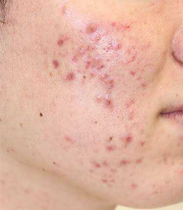 コロナ禍でできる肌の赤みやニキビに効くおすすめの薬品 Greenyossyのブログ 楽天ブログ