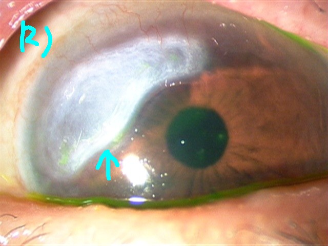 周辺部角膜潰瘍１.jpg
