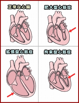 心筋症