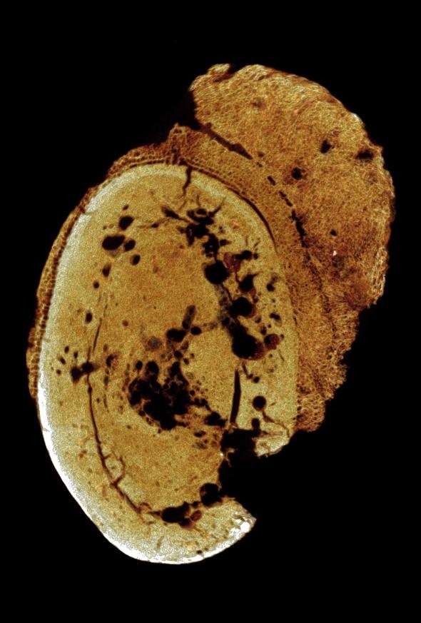 １７０万年前の癌の断面