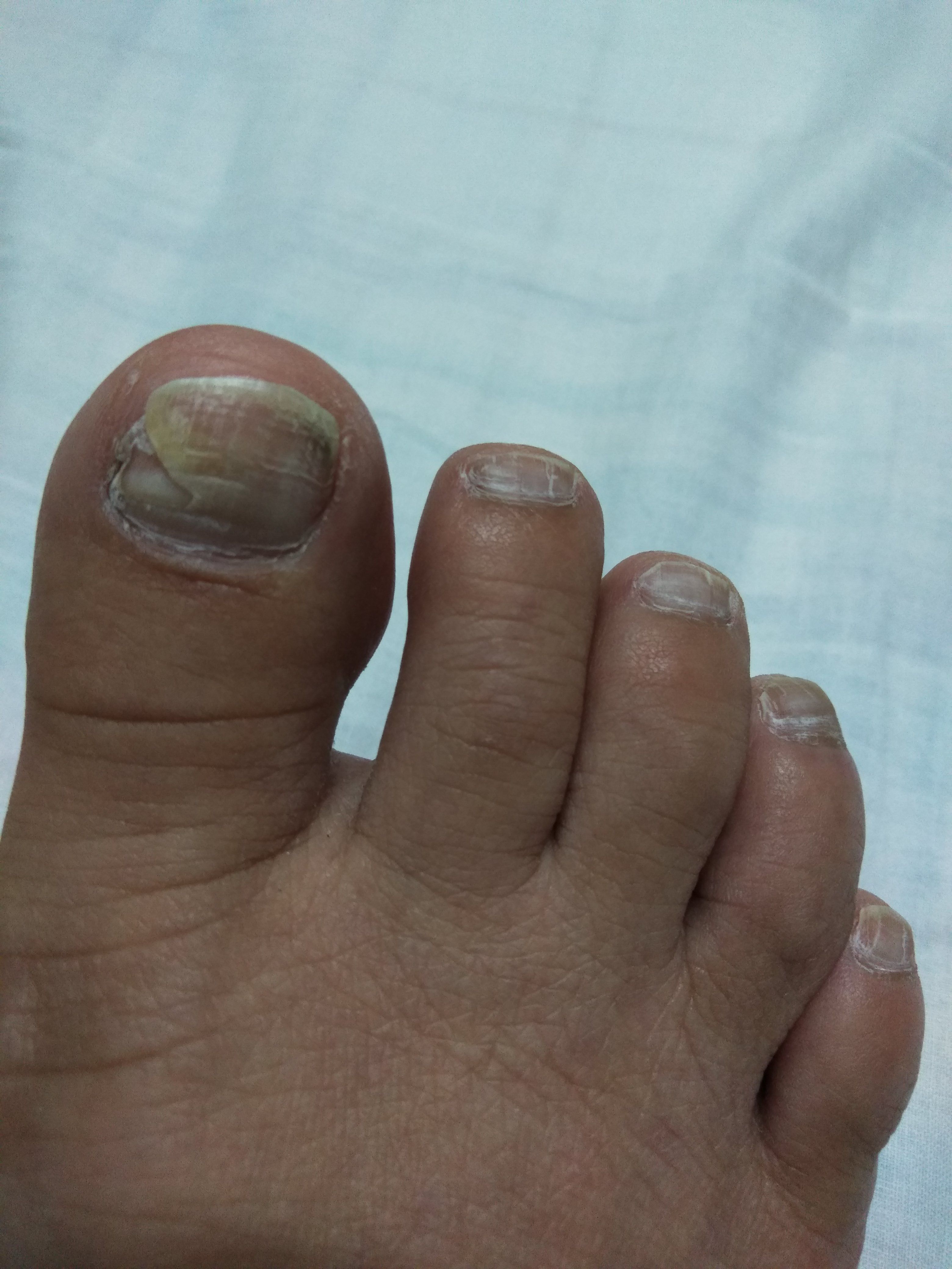 足 の 親指 の 爪 が 剥がれ た