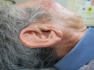 整体すると 動脈硬化の為の耳たぶの深いシワも改善されます 笹岡整骨院の独り言 東洋医学の現場で働く治療師日記 楽天ブログ