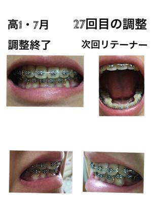 長男のリテーナー生活 近況 大学生と高校生 3歳差兄弟の母が綴る日記 楽天ブログ