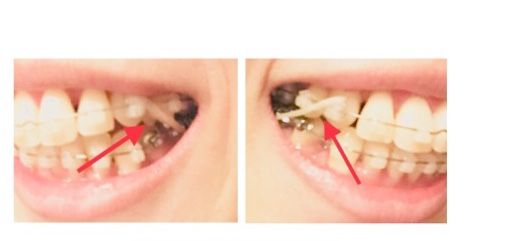 歯列矯正 おひとりさまのシンプルライフ 楽天ブログ