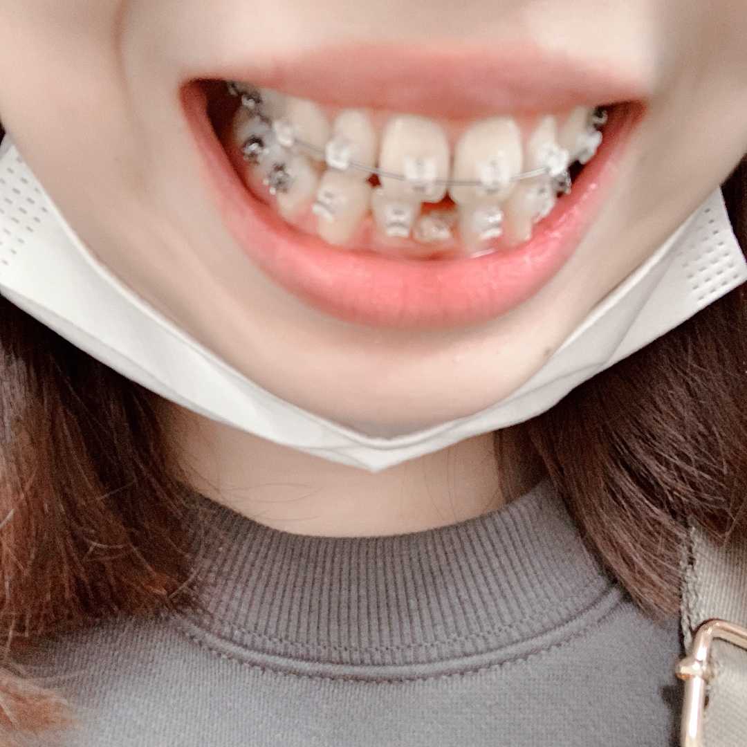 カテゴリ未分類 代女の歯列矯正 出っ歯 楽天ブログ