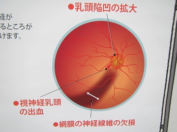 病院７緑内障１.jpg