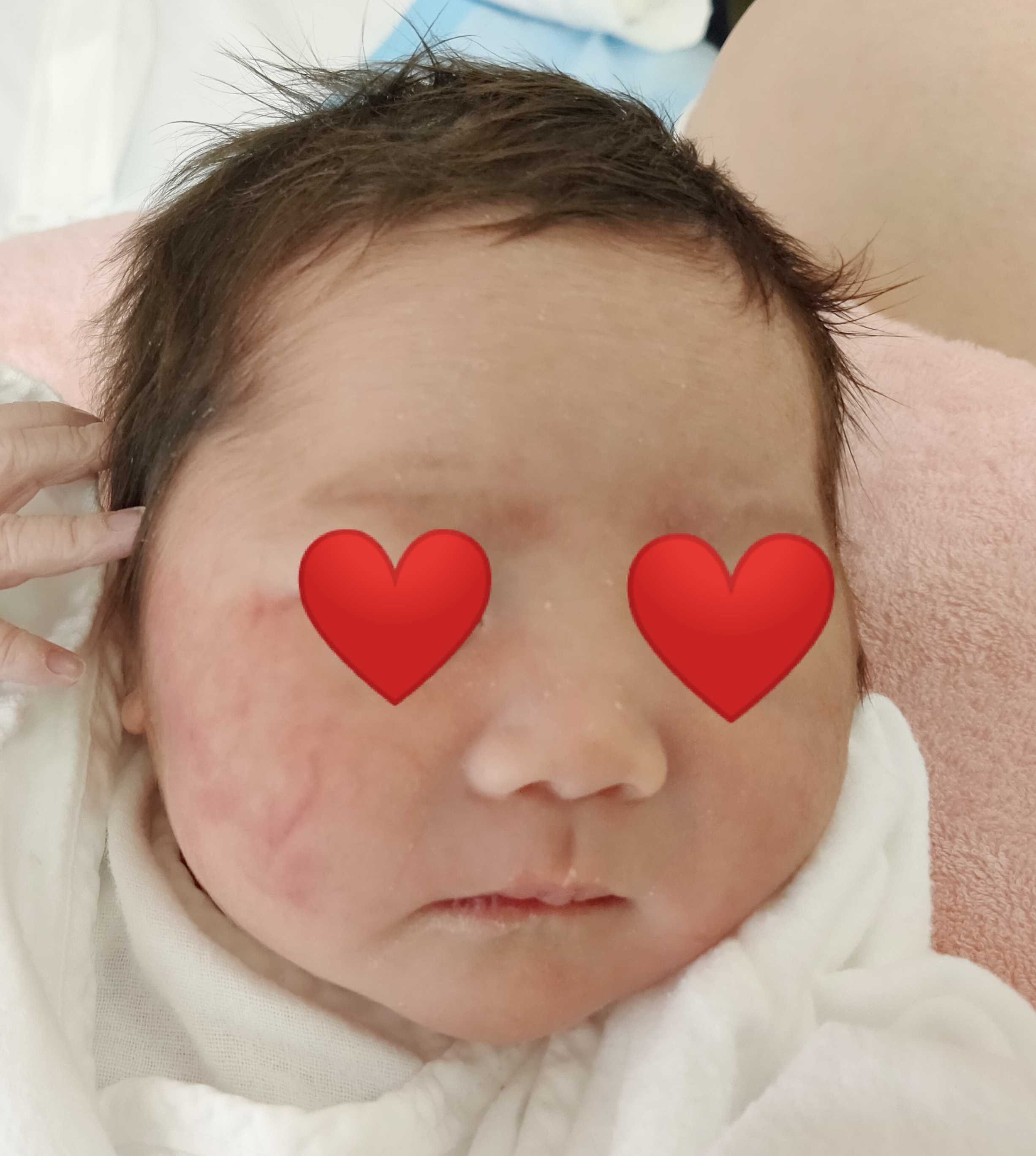 生まれた長女の顔にあった赤いアザ ３人年子母の 日々と買い物と毒と ー 楽天ブログ