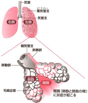 lung.jpg 間質性肺炎.jpg