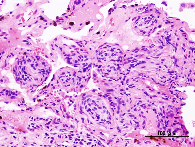 chemodectoma_lung