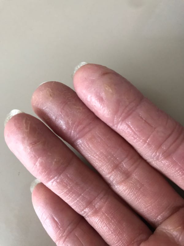主婦湿疹 指先のカサカサ手荒れにポリエチ手袋を クサノタヨリ 楽天ブログ