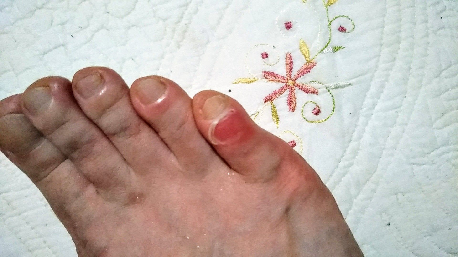 足の指がむくんで皮が剥けた 病気と生きる 楽天ブログ