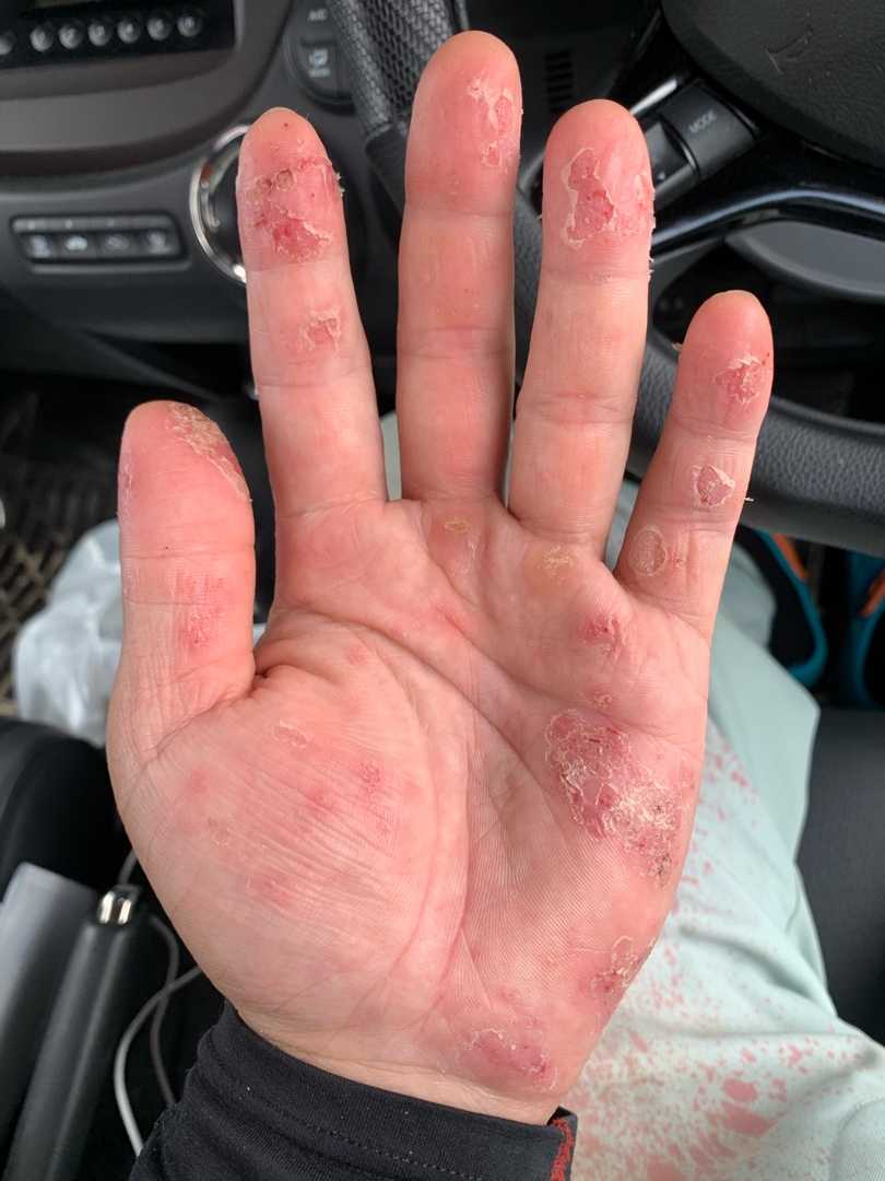 手湿疹 釣りやらなんやらブログ 楽天ブログ